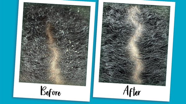 Before and after of a hair scalp
